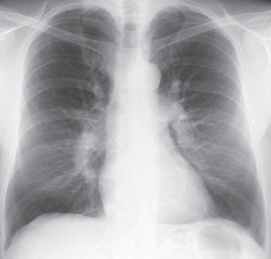 An enlarged pulmonary artery appears smooth and larger than the bronchus intermedius in the right lower lobe.