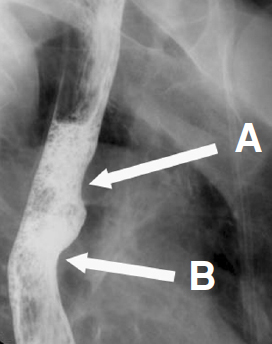  Aortic arch (A) and left mainstem bronchus (B)